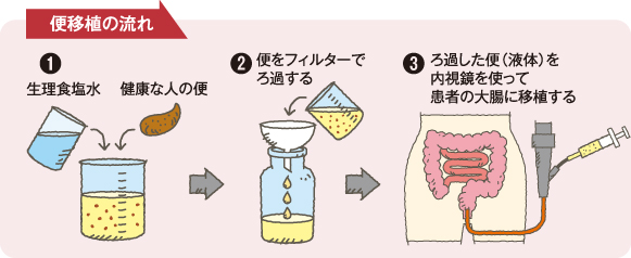 注目を集める新しい試み「便移植」